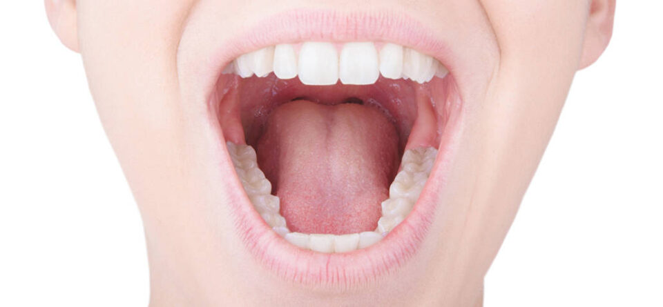 estrazione dente giudizio